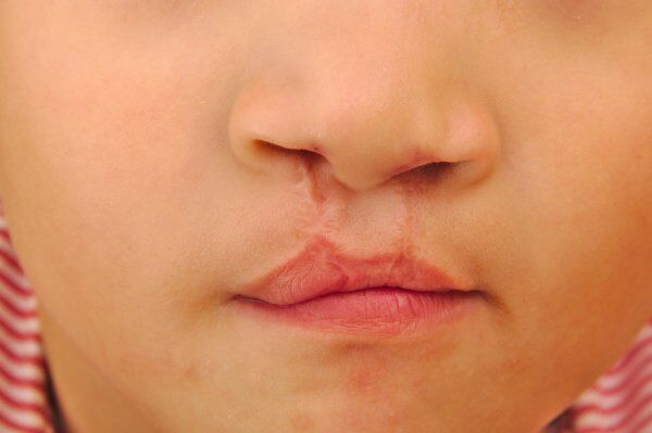 c left lip Cleft Surgery dull skin cream Quantity:1 Box 600mg Glutavah Glutathione Injection,